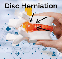 Hickory NC Chiropractor Disc Herniation