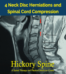 Neck Disc Herniation Chiropractic Treatment Hickory NC